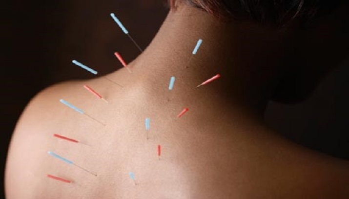 acupuncture and spine health